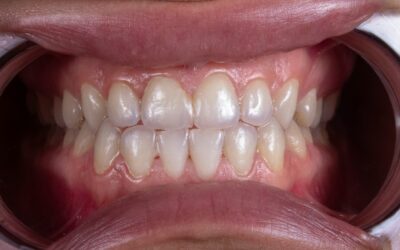 Whitening vs Veneers: Which Option Is Right for Your Smile?