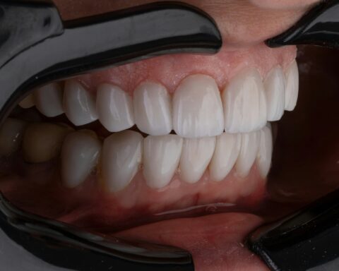 Single Tooth Dentures: Everything You Need to Know