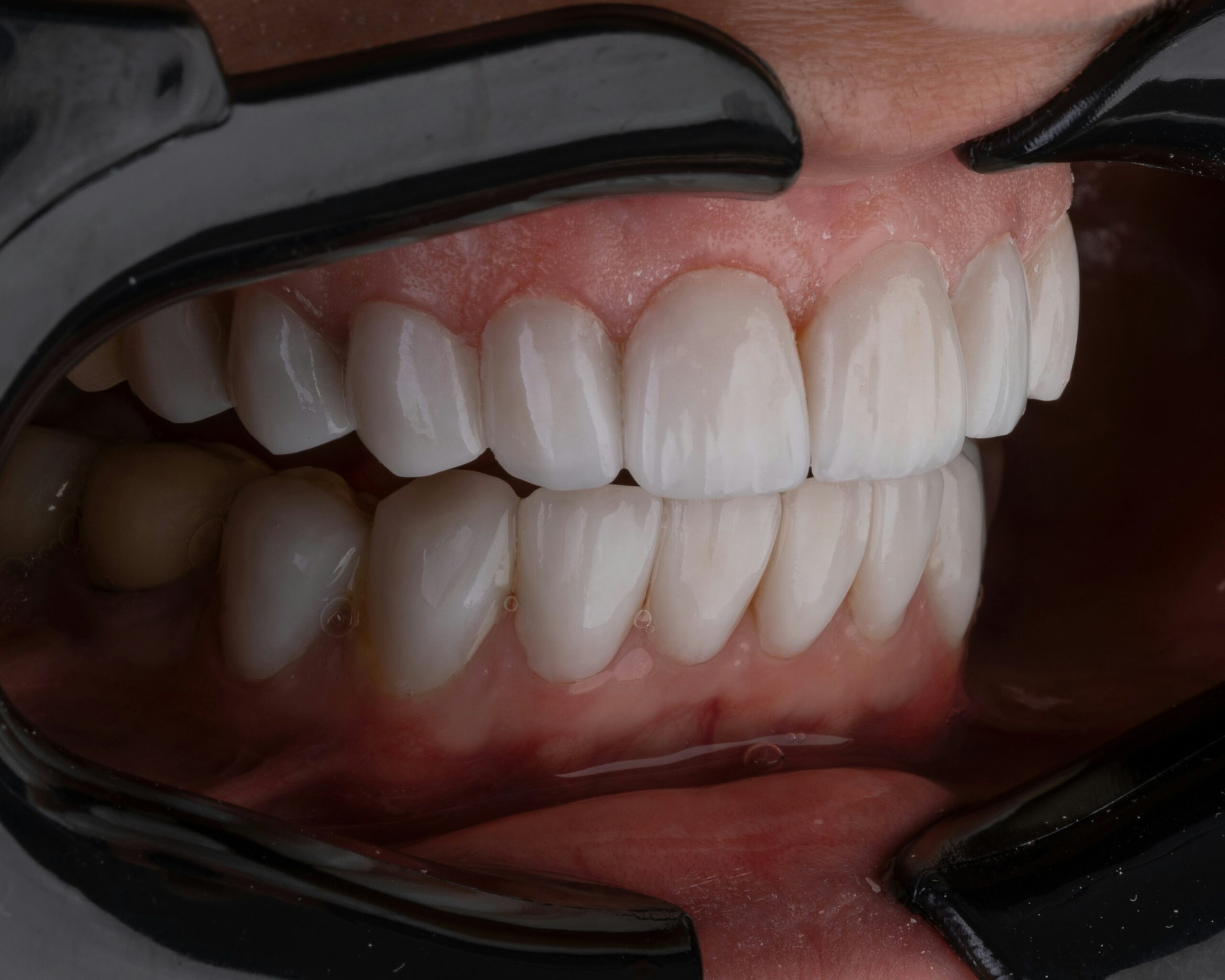 single tooth denture single tooth denture