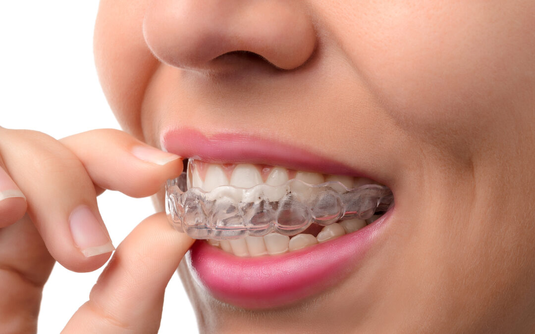 Straightening your teeth with Invisalign